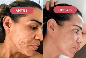 Tratamento anti-idade Skin Complex Plus, muito mais que um simples colágeno! Resultados visíveis já no primeiro mês de uso! Mulher mostrando o rosto de perfil antes e após o uso do tratamento anti-idade Skin Complex Plus