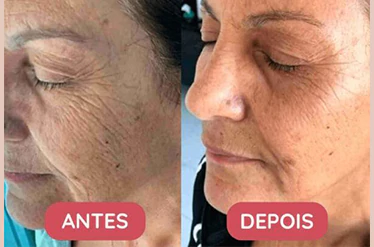 Tratamento anti-idade Skin Complex Plus, muito mais que um simples colágeno! Resultados visíveis já no primeiro mês de uso! Mulher mostrando o rosto de perfil antes e após o uso do tratamento anti-idade Skin Complex Plus