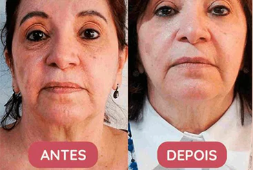 Tratamento anti-idade Skin Complex Plus, muito mais que um simples colágeno! Resultados visíveis já no primeiro mês de uso! Close do rosto de uma mulher antes e após o uso do tratamento anti-idade Skin Complex Plus;